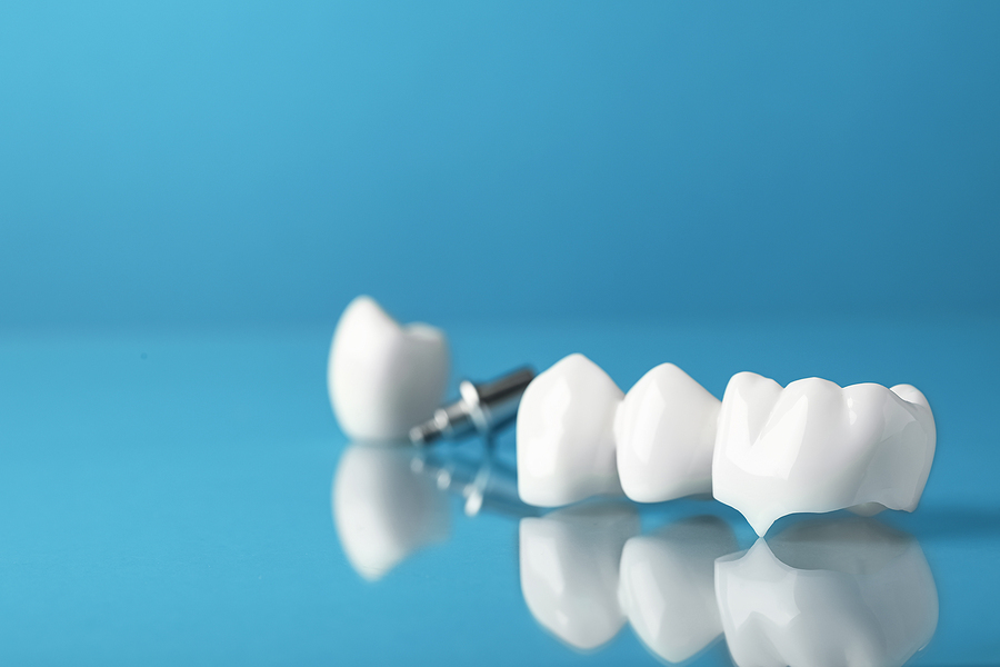 Restoring Your Smile with Crowns & Bridges in Alachua, FL