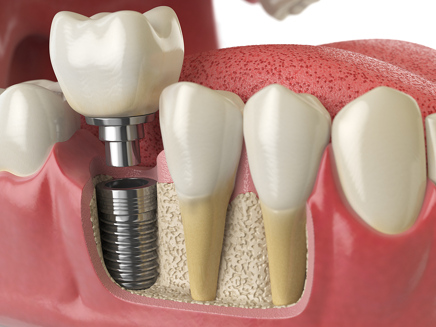 Restore Your Smile with Dental Implants in Alachua, FL