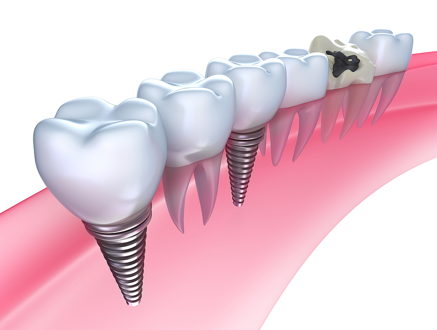 Restore Your Smile with Dental Implants: A Guide to Permanent Tooth Replacement