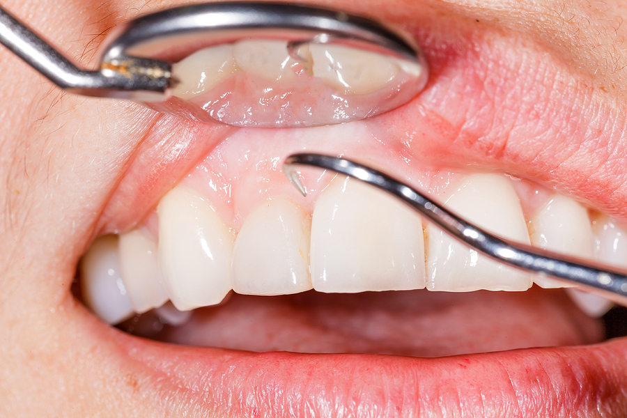 Essential Tips for Prevention & Gum Care in Alachua, FL