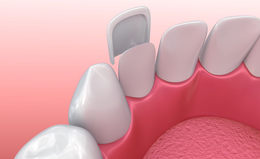 Achieve Your Dream Smile with Veneers: A Guide to Enhancing Dental Aesthetics