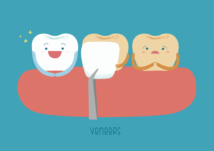 Transform Your Smile with Veneers in Alachua, FL